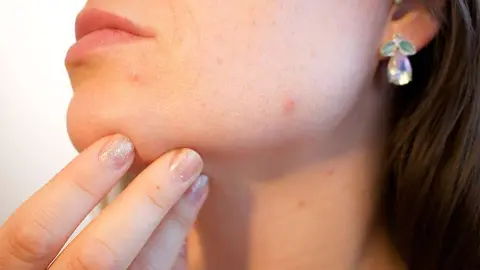 acne-1606765_1280